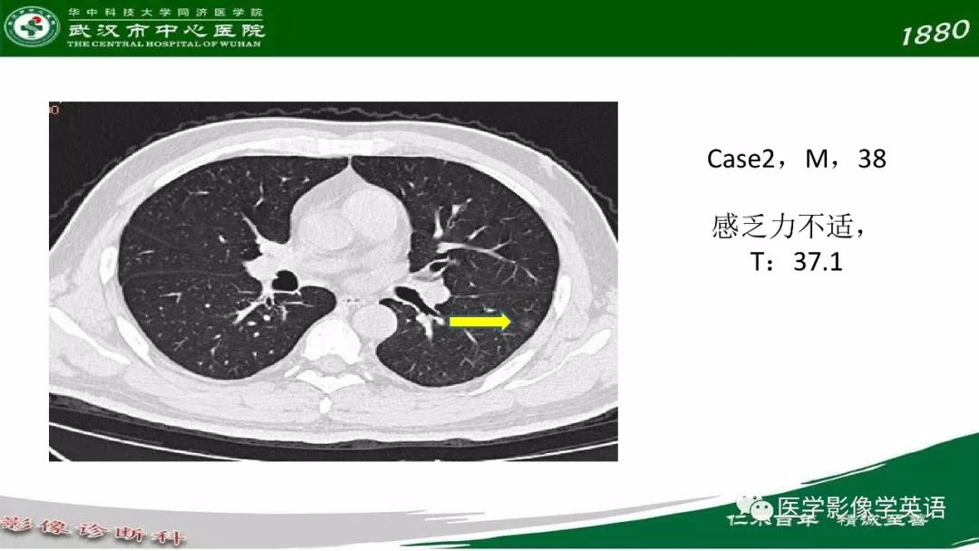 【PPT】易被忽视的疑似2019-nCoV病毒性肺炎