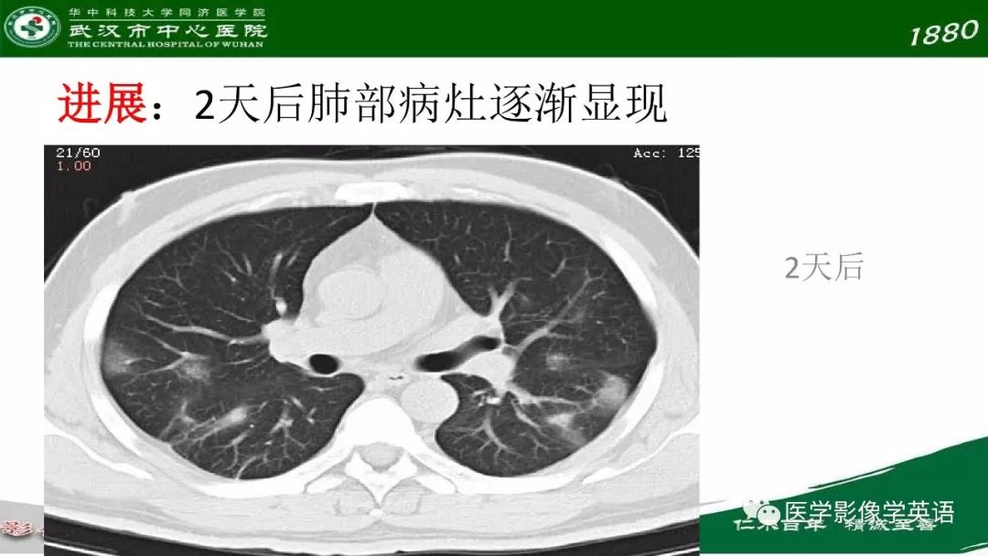 【PPT】易被忽视的疑似2019-nCoV病毒性肺炎
