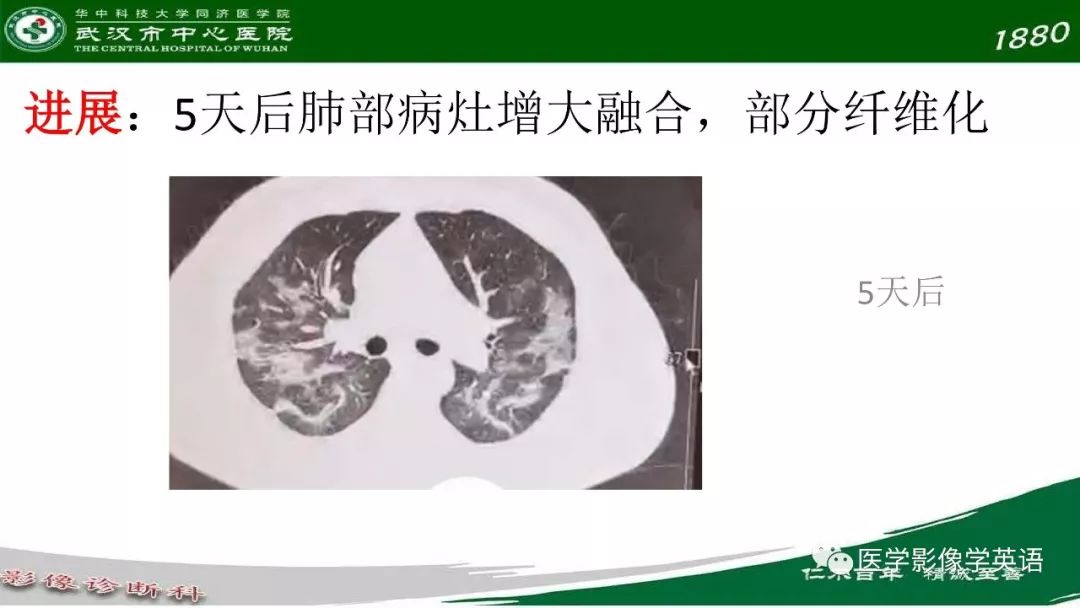 【PPT】易被忽视的疑似2019-nCoV病毒性肺炎