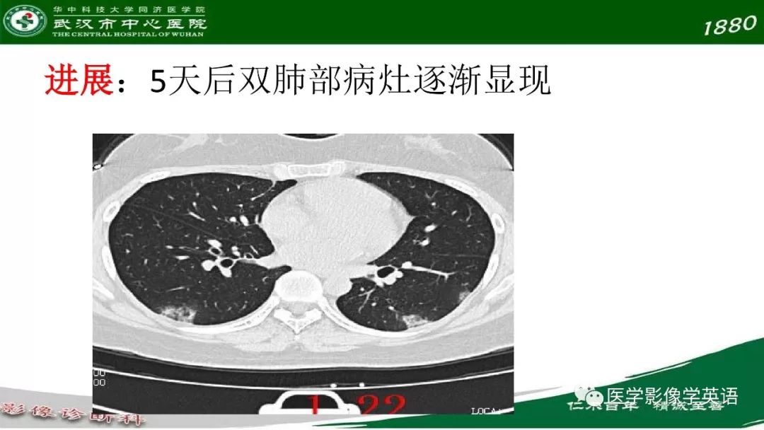 【PPT】易被忽视的疑似2019-nCoV病毒性肺炎