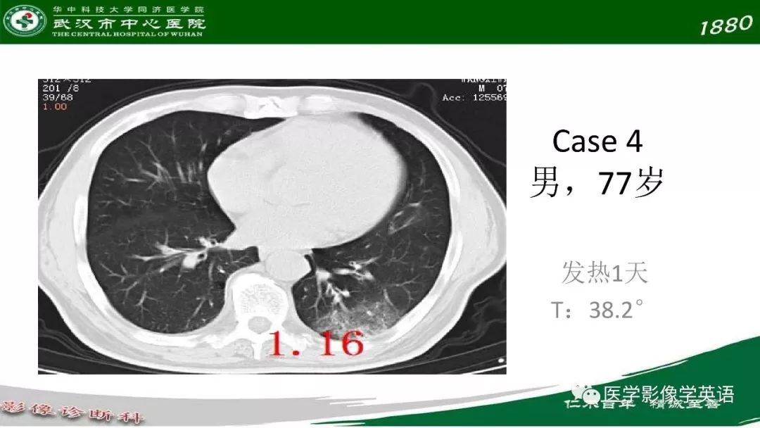 【PPT】易被忽视的疑似2019-nCoV病毒性肺炎
