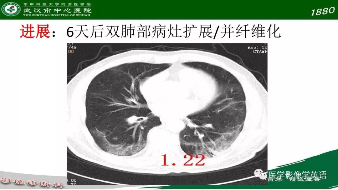 【PPT】易被忽视的疑似2019-nCoV病毒性肺炎