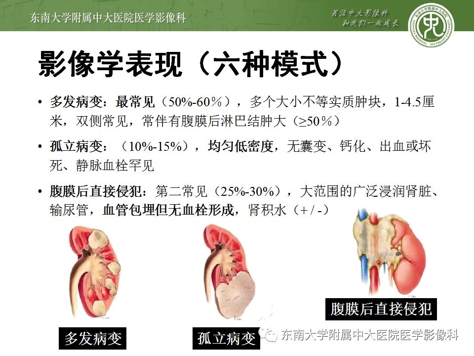 【PPT】肾脏淋巴瘤