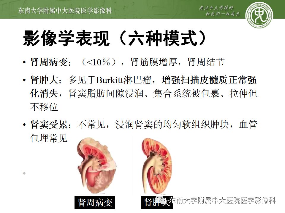 【PPT】肾脏淋巴瘤
