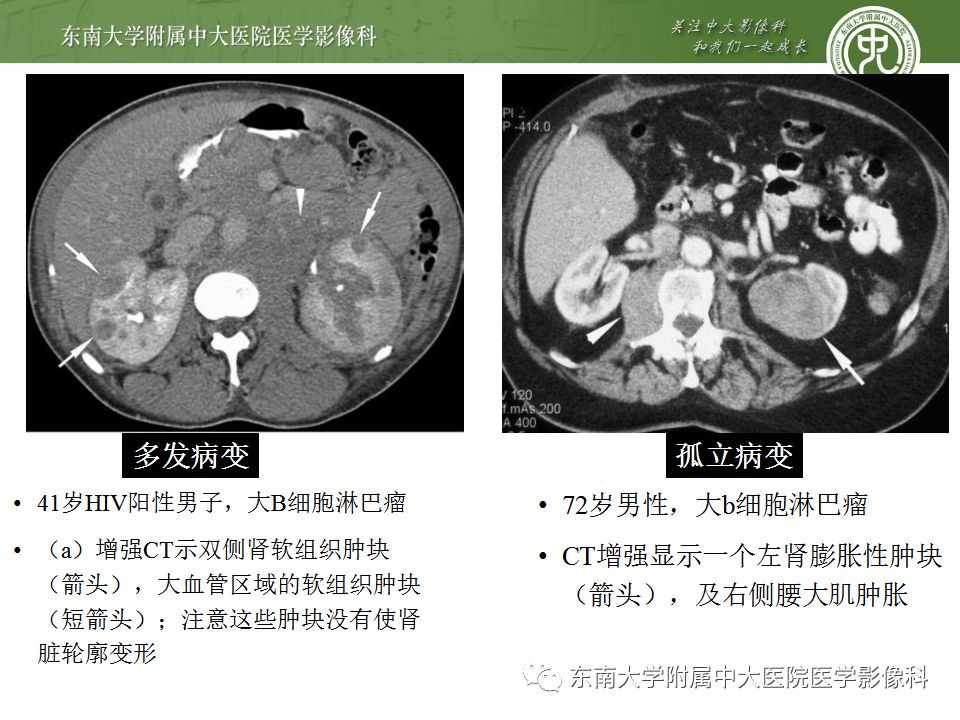 【PPT】肾脏淋巴瘤