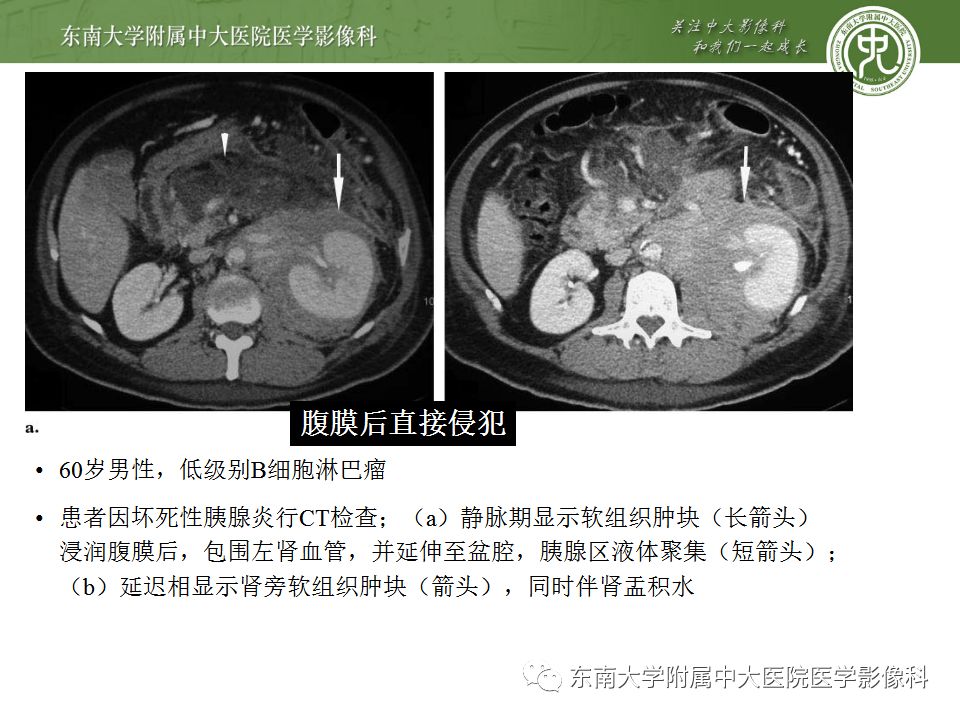 【PPT】肾脏淋巴瘤