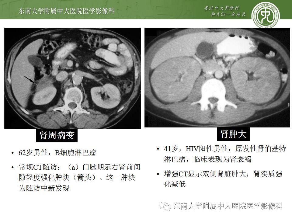 【PPT】肾脏淋巴瘤