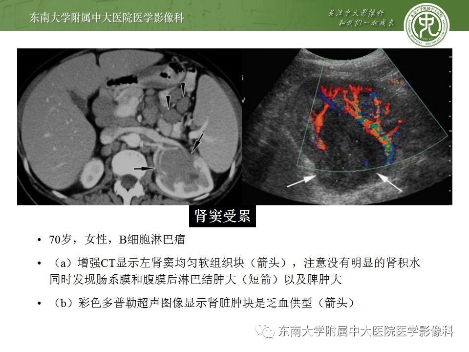 【PPT】肾脏淋巴瘤