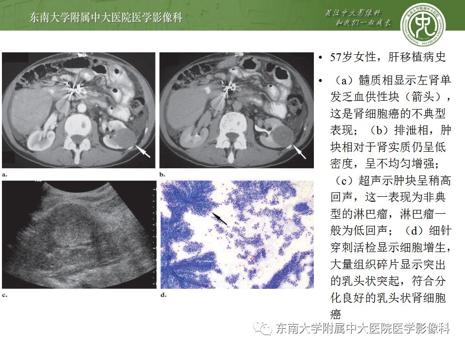 【PPT】肾脏淋巴瘤