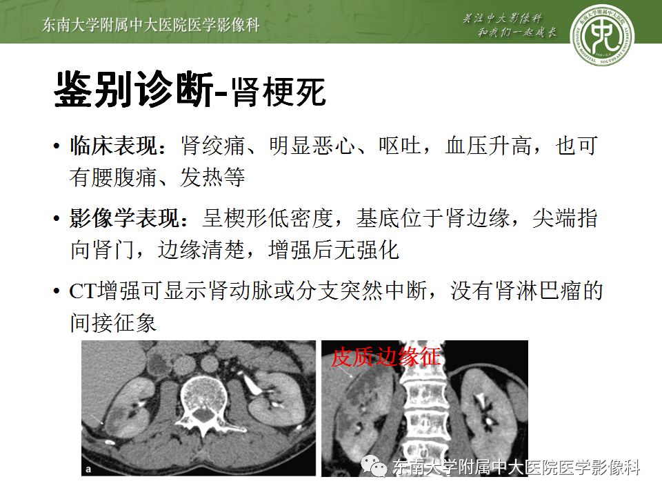 【PPT】肾脏淋巴瘤
