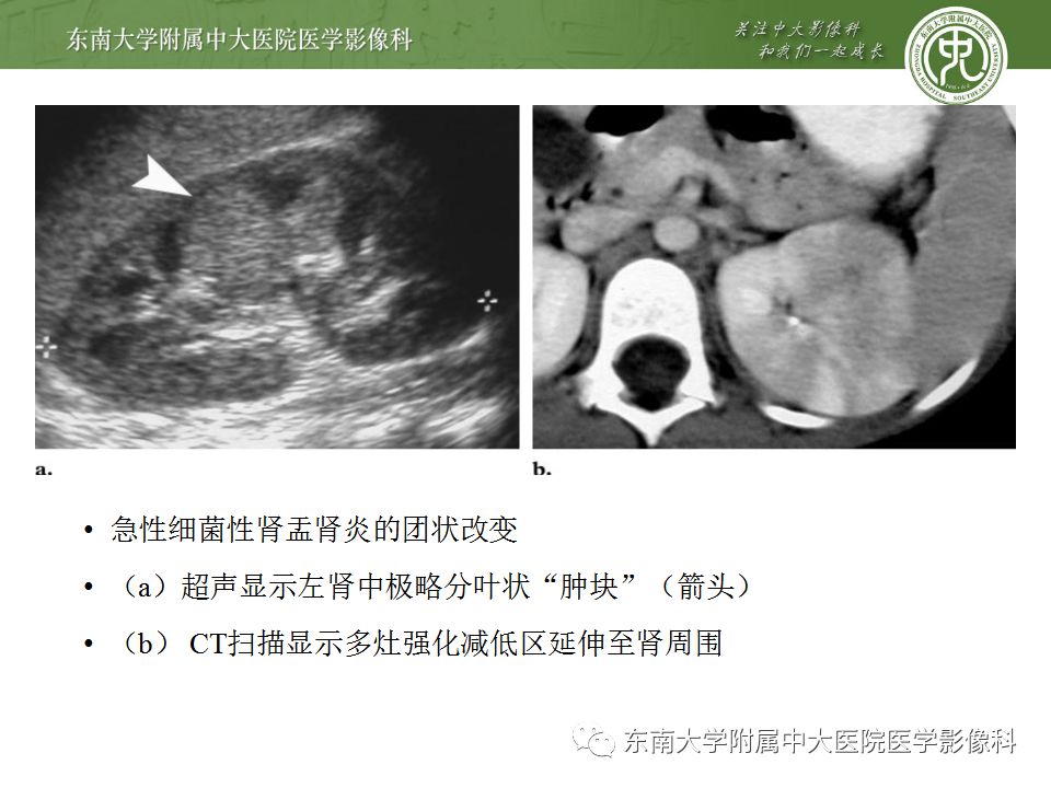 【PPT】肾脏淋巴瘤