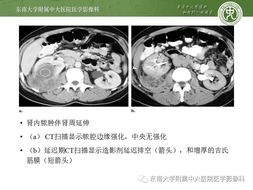 【PPT】肾脏淋巴瘤