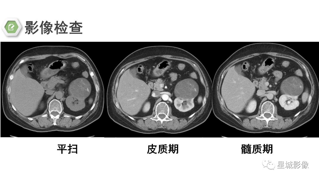 【PPT】肾混合性上皮和间质肿瘤
