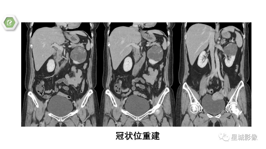【PPT】肾混合性上皮和间质肿瘤
