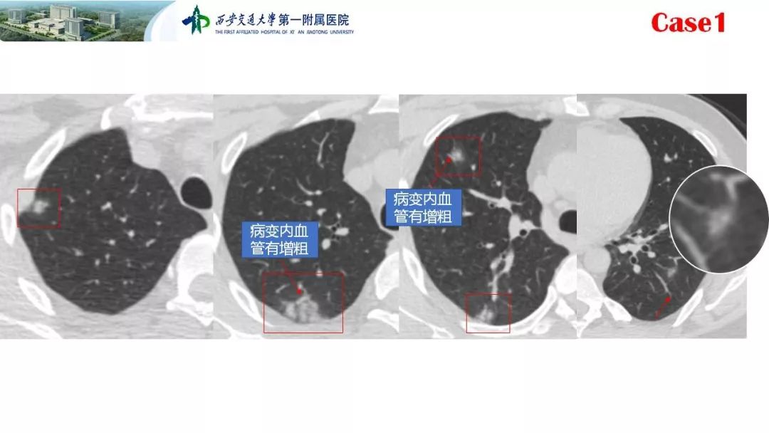 【PPT】19-nCoV患者影像学病例分享第一期
