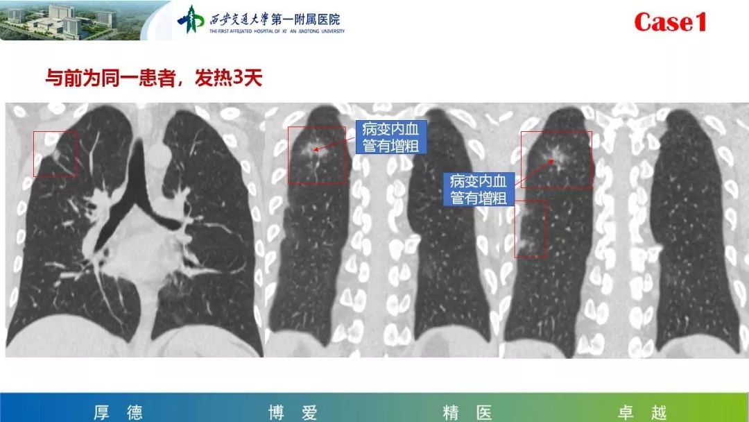 【PPT】19-nCoV患者影像学病例分享第一期