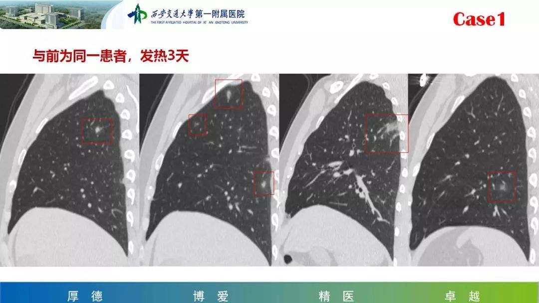 【PPT】19-nCoV患者影像学病例分享第一期