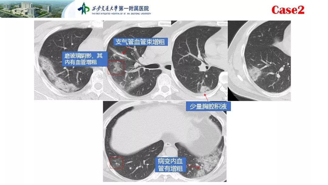 【PPT】19-nCoV患者影像学病例分享第一期