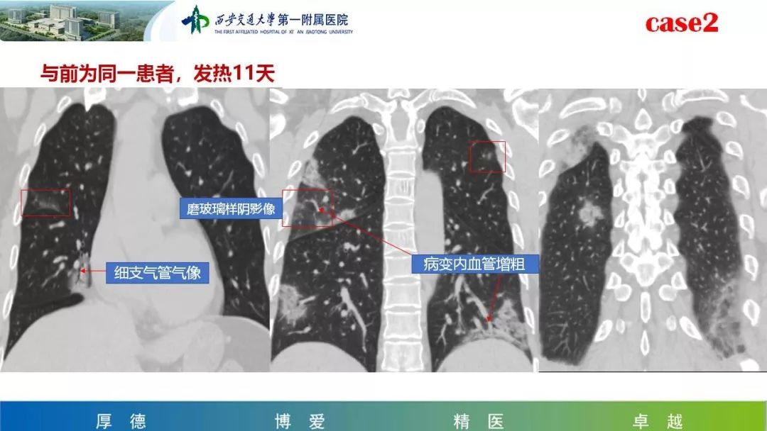 【PPT】19-nCoV患者影像学病例分享第一期