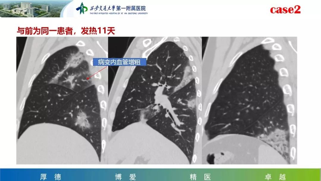 【PPT】19-nCoV患者影像学病例分享第一期