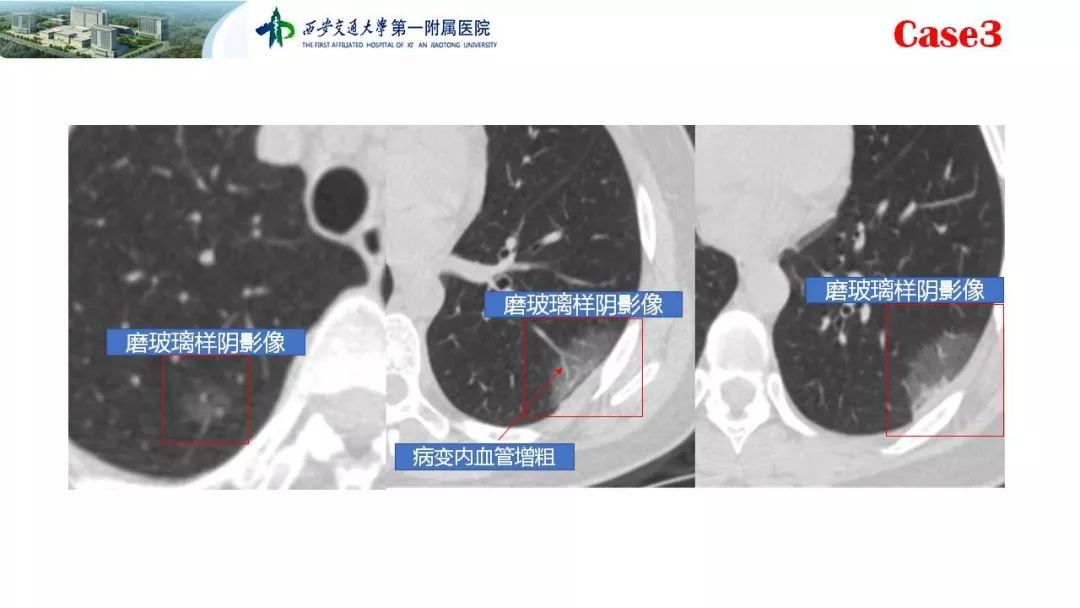 【PPT】19-nCoV患者影像学病例分享第一期