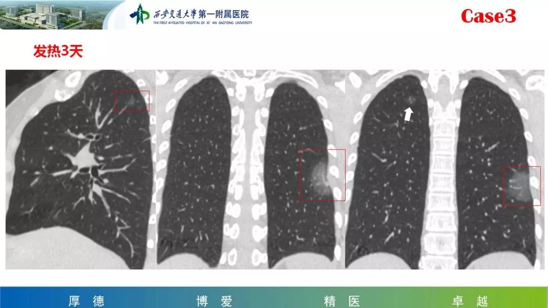 【PPT】19-nCoV患者影像学病例分享第一期