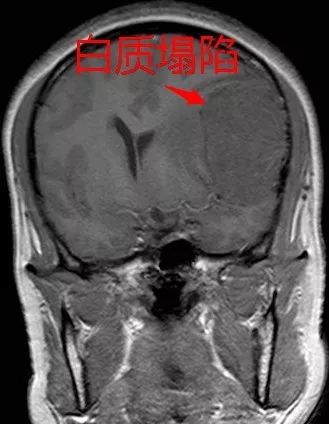脑膜瘤的3种少见特异性征象 脑膜瘤的3种少见特异性征象