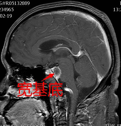 脑膜瘤的3种少见特异性征象 脑膜瘤的3种少见特异性征象