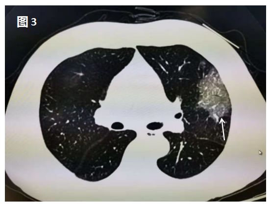 新型冠状病毒肺炎在肺部CT上是这样的 新型冠状病毒肺炎在肺部CT上是这样的