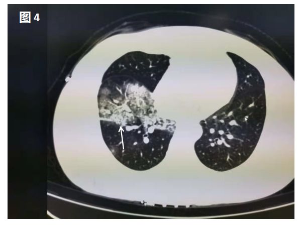 新型冠状病毒肺炎在肺部CT上是这样的 新型冠状病毒肺炎在肺部CT上是这样的