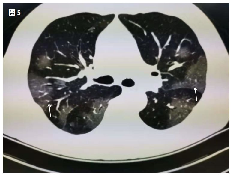 新型冠状病毒肺炎在肺部CT上是这样的 新型冠状病毒肺炎在肺部CT上是这样的