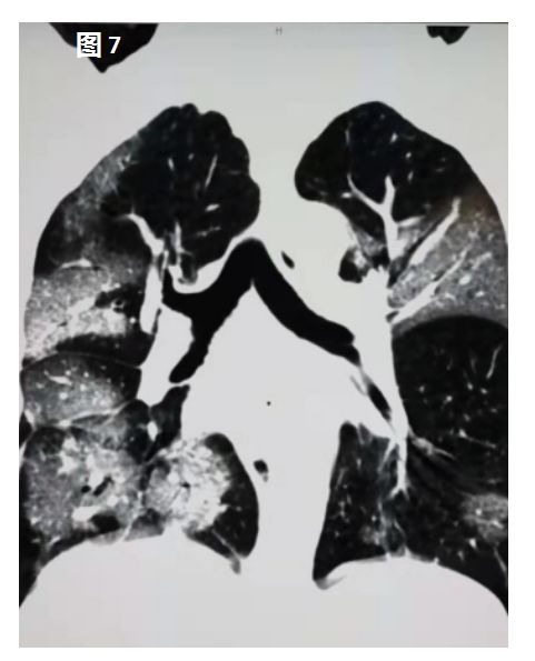 新型冠状病毒肺炎在肺部CT上是这样的 新型冠状病毒肺炎在肺部CT上是这样的