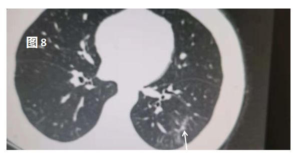 新型冠状病毒肺炎在肺部CT上是这样的 新型冠状病毒肺炎在肺部CT上是这样的