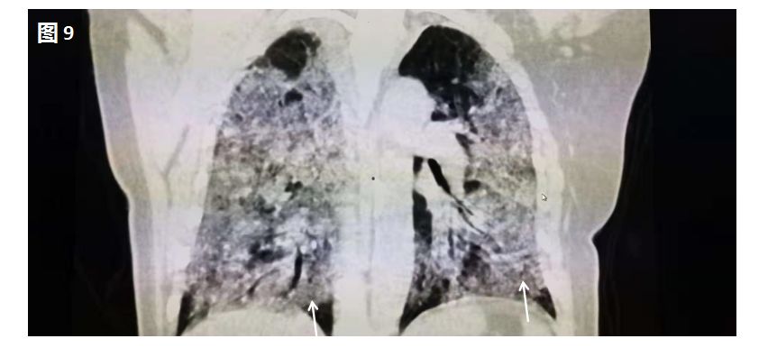 新型冠状病毒肺炎在肺部CT上是这样的 新型冠状病毒肺炎在肺部CT上是这样的