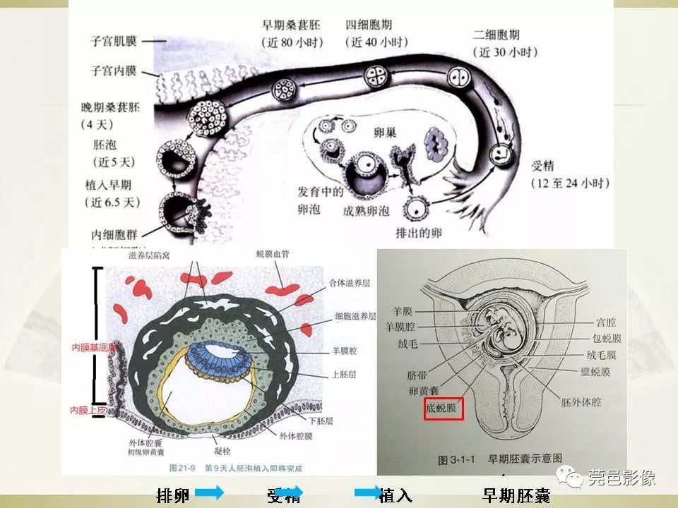 【PPT】剖宫产术后子宫瘢痕妊娠MRI诊断