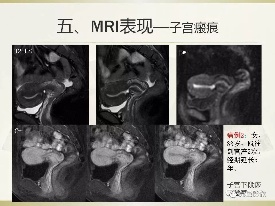 【PPT】剖宫产术后子宫瘢痕妊娠MRI诊断