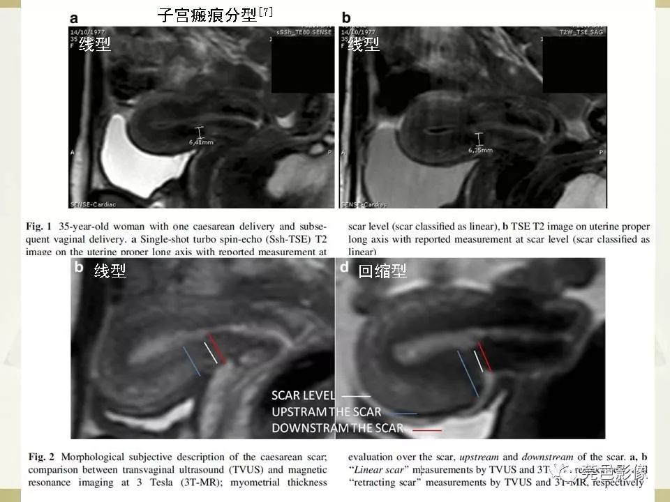 【PPT】剖宫产术后子宫瘢痕妊娠MRI诊断