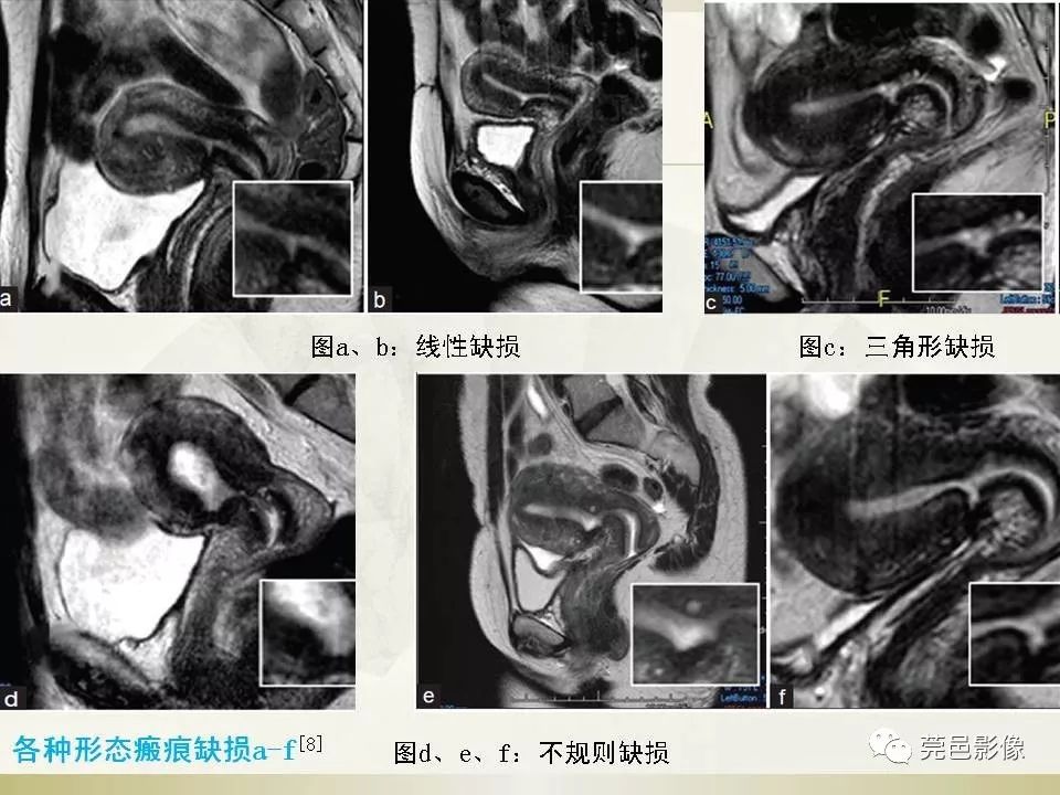 【PPT】剖宫产术后子宫瘢痕妊娠MRI诊断
