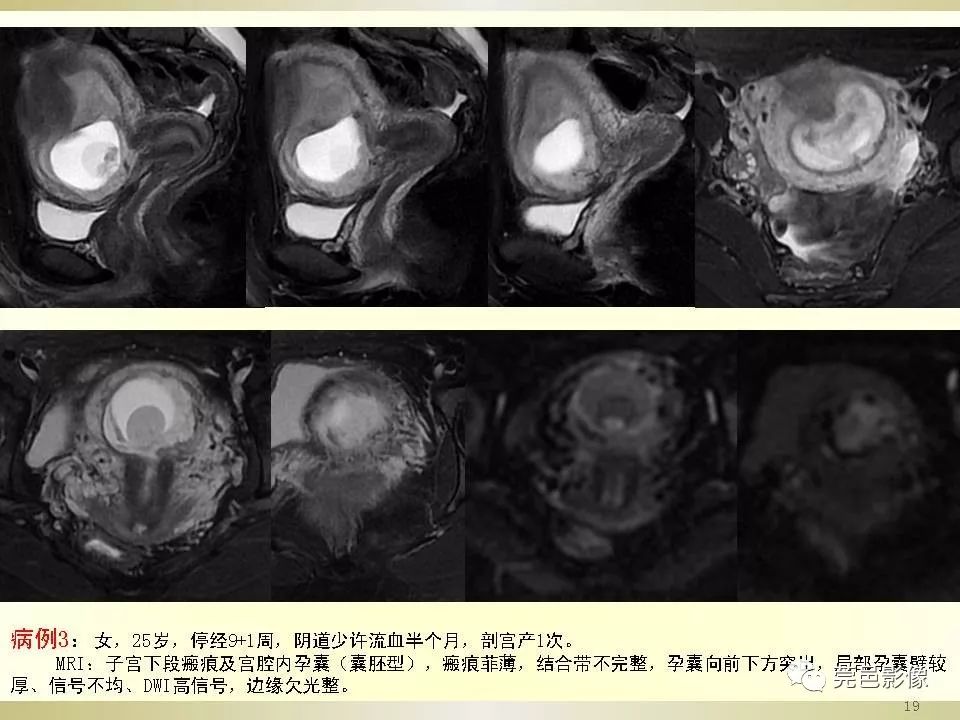 【PPT】剖宫产术后子宫瘢痕妊娠MRI诊断