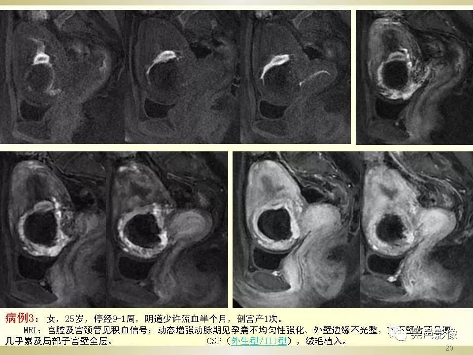 【PPT】剖宫产术后子宫瘢痕妊娠MRI诊断