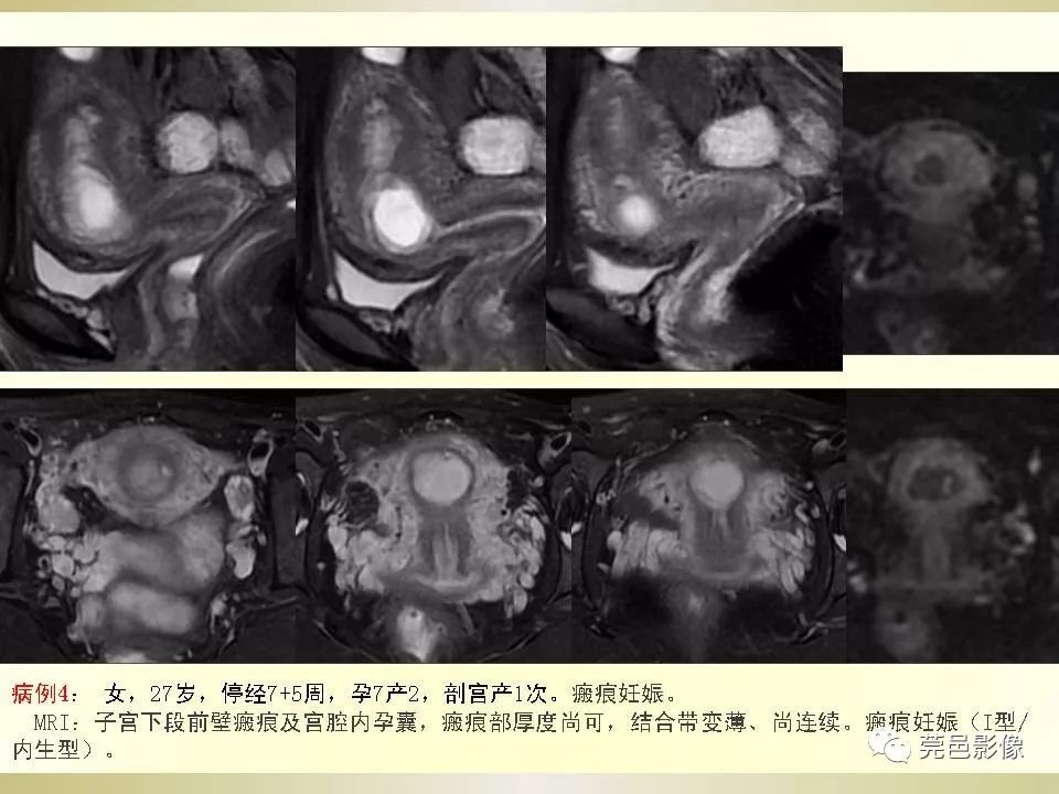 【PPT】剖宫产术后子宫瘢痕妊娠MRI诊断