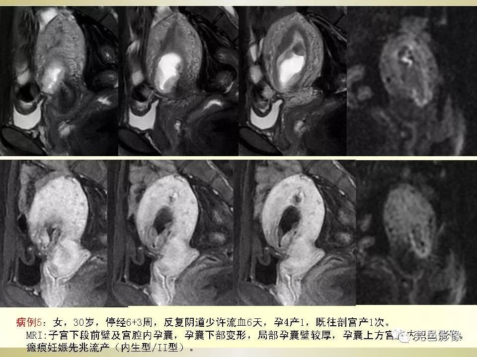 【PPT】剖宫产术后子宫瘢痕妊娠MRI诊断