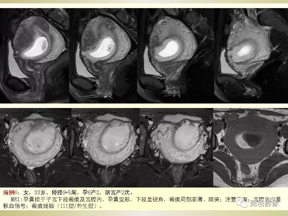 【PPT】剖宫产术后子宫瘢痕妊娠MRI诊断