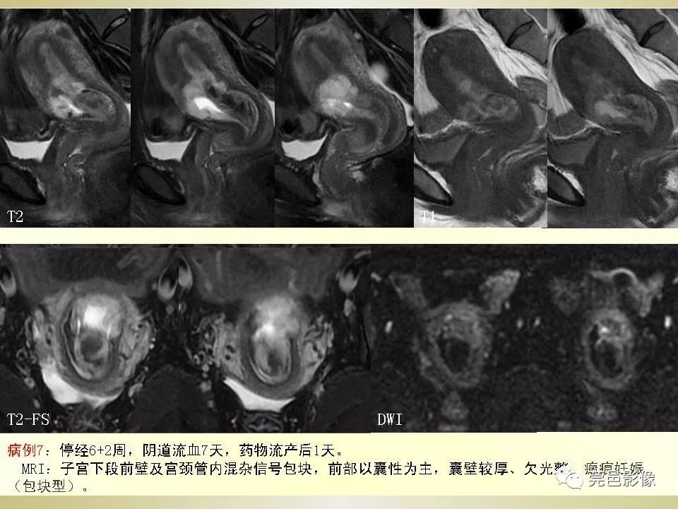 【PPT】剖宫产术后子宫瘢痕妊娠MRI诊断