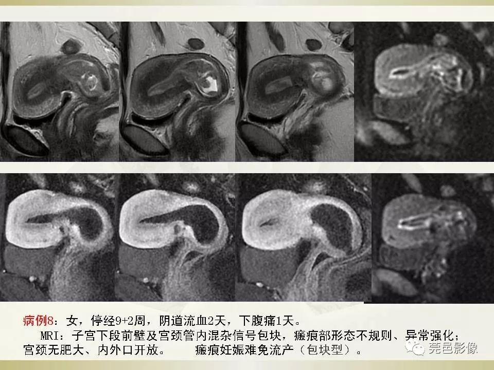 【PPT】剖宫产术后子宫瘢痕妊娠MRI诊断