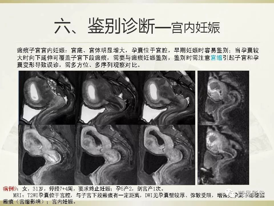 【PPT】剖宫产术后子宫瘢痕妊娠MRI诊断