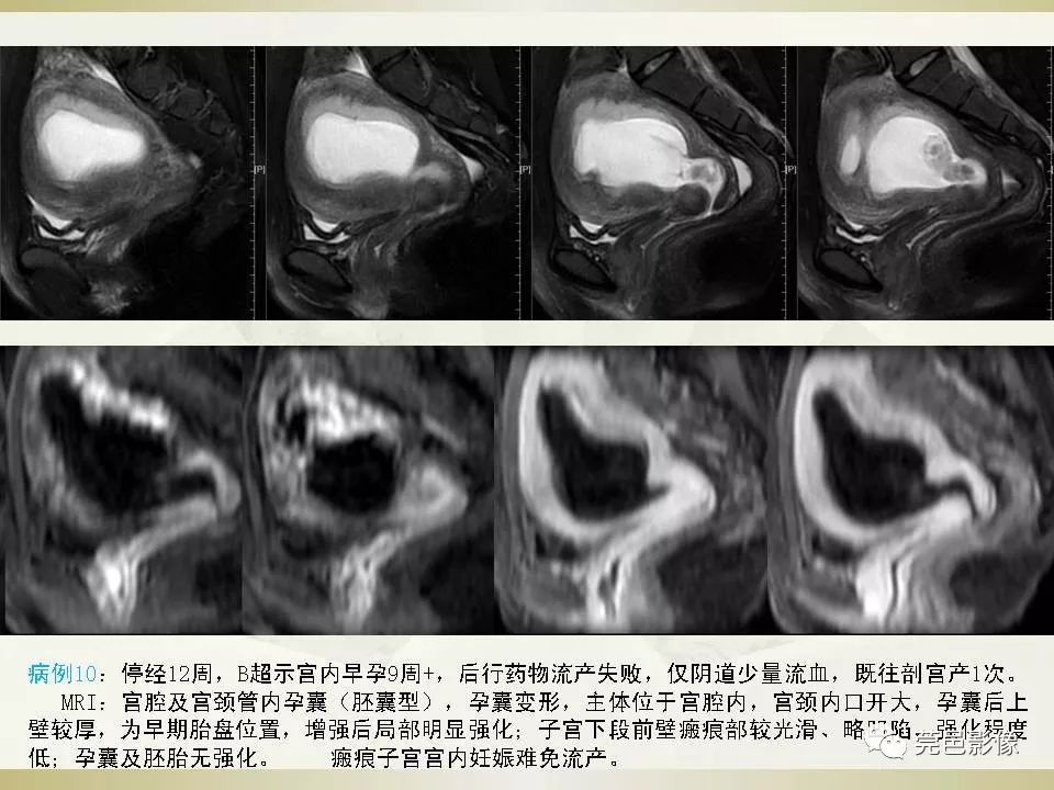【PPT】剖宫产术后子宫瘢痕妊娠MRI诊断
