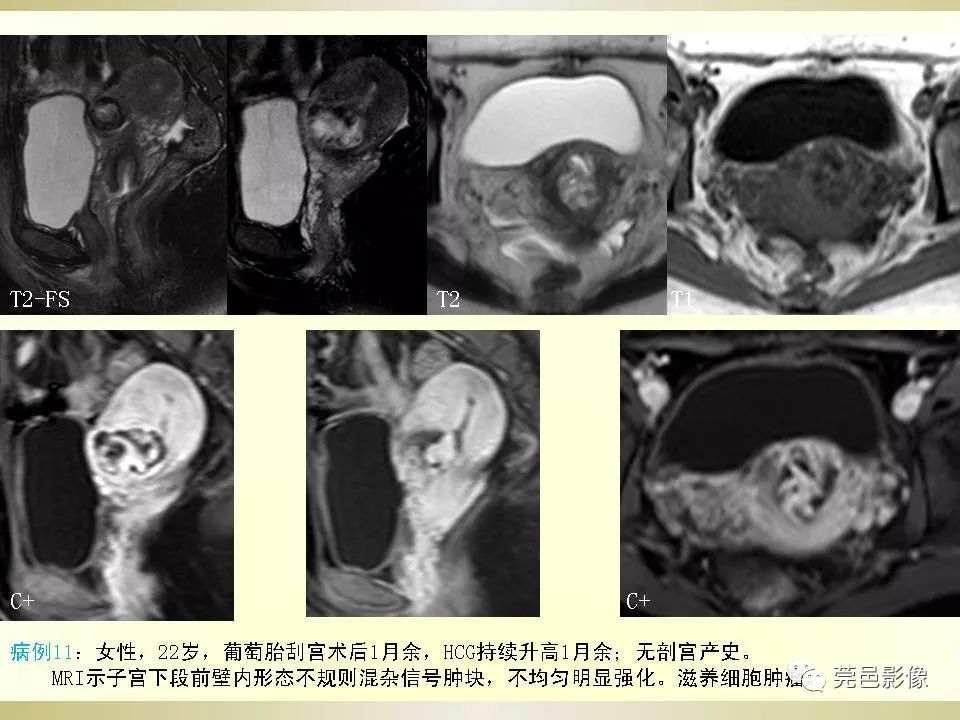 【PPT】剖宫产术后子宫瘢痕妊娠MRI诊断