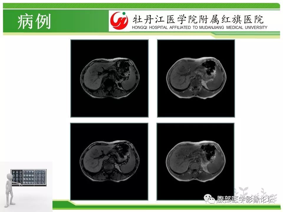 【病例】肝脏局限性慢性炎症1例MR影像