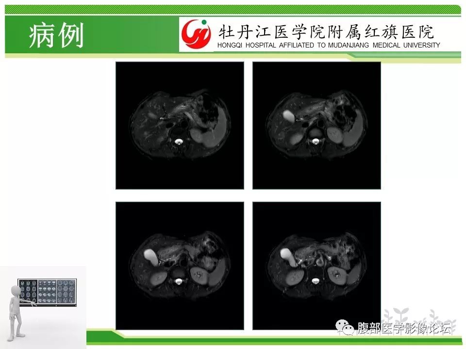 【病例】肝脏局限性慢性炎症1例MR影像